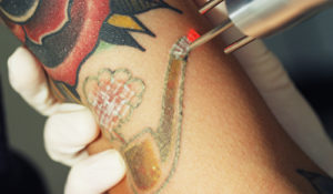 laser tattoo removal wichita kansas
