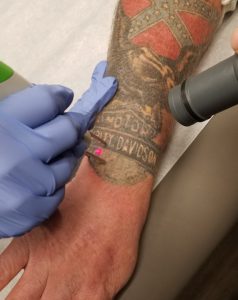 Laser tattoo removal wichita ks